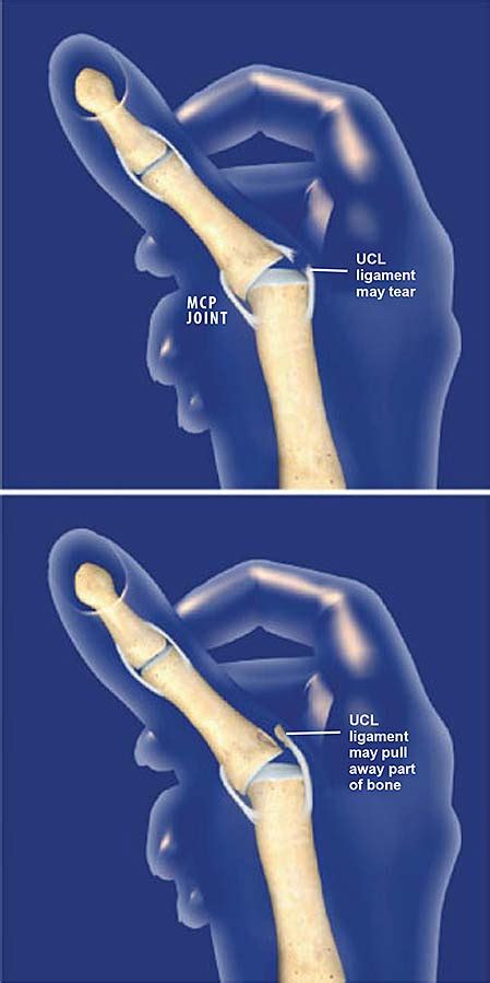 ucl thumb injury prognosis